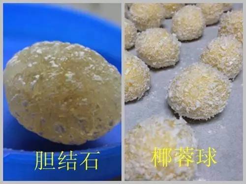 世界快讯:云南保胆手术案例：怪事！患胆结石14年如愿保胆，竟取出一颗“椰蓉球”